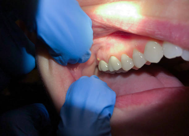 Best Tooth Infection Emergency Dentist  in Gordo, AL